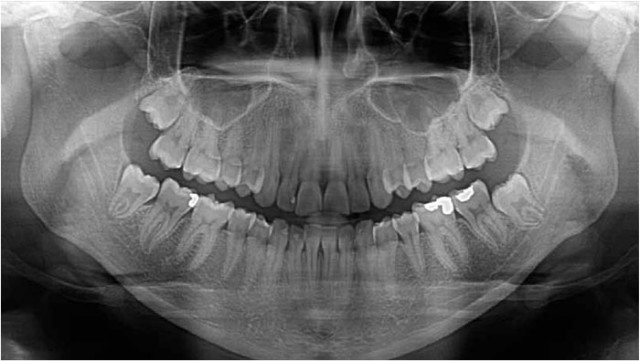 digital-panoramic-xray.jpg